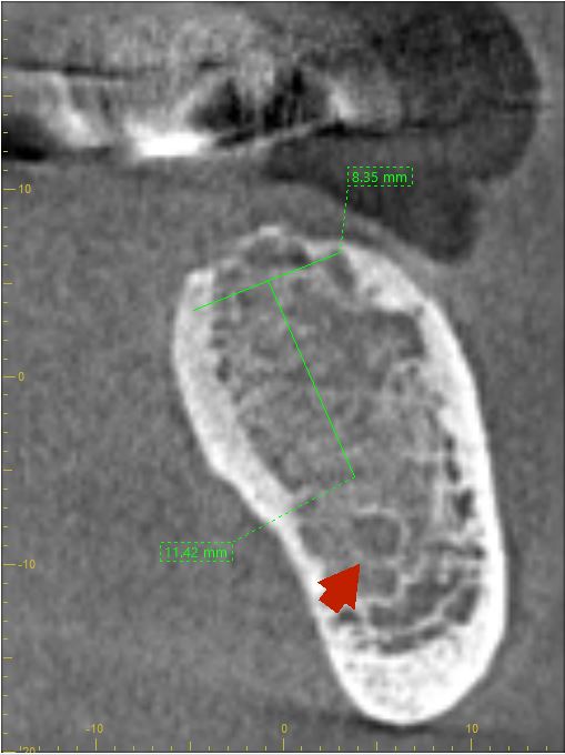 A Cone Beam CT (CBCT) cross section of the mandible for implant placement 