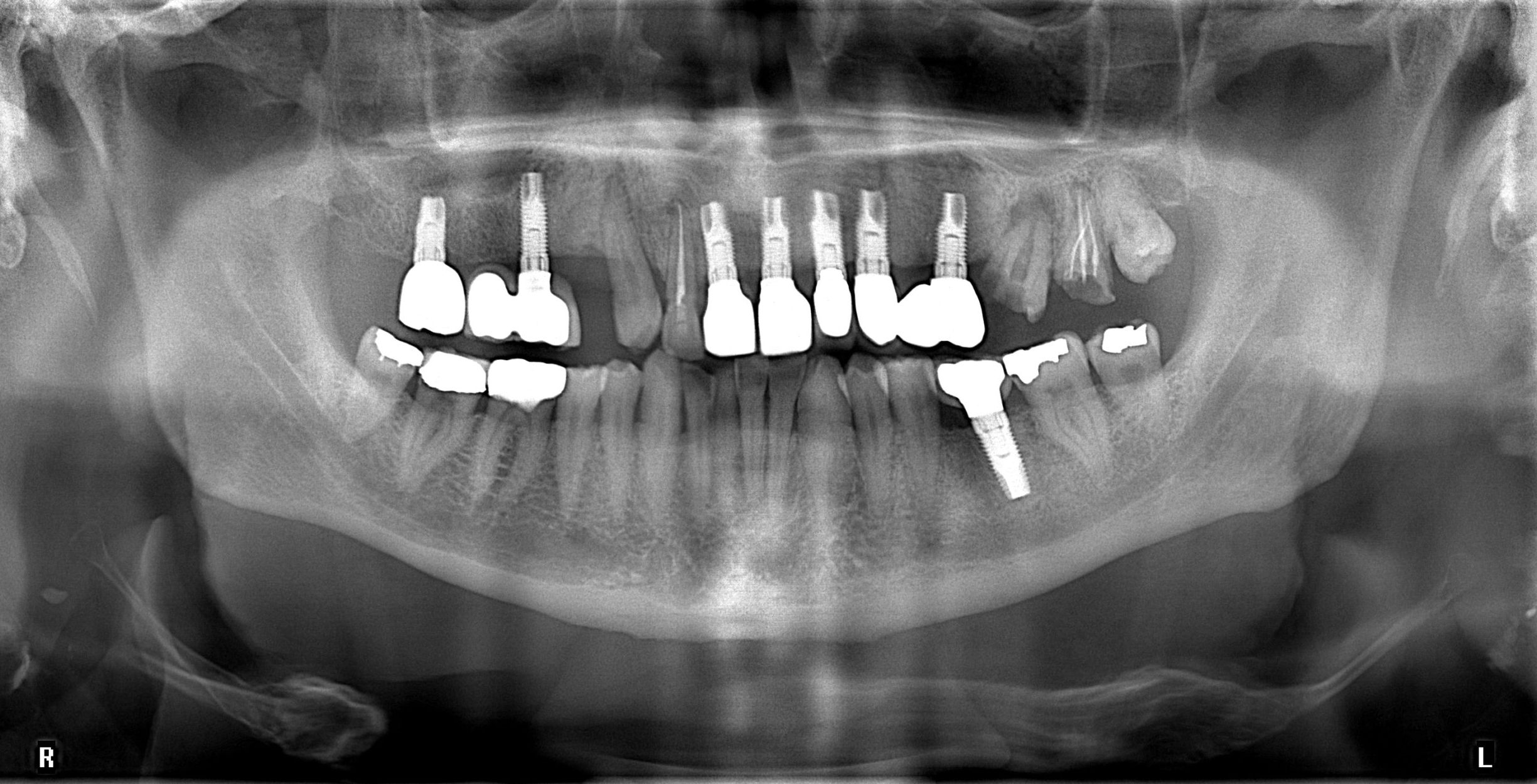 OPG dental x-ray with dental implants