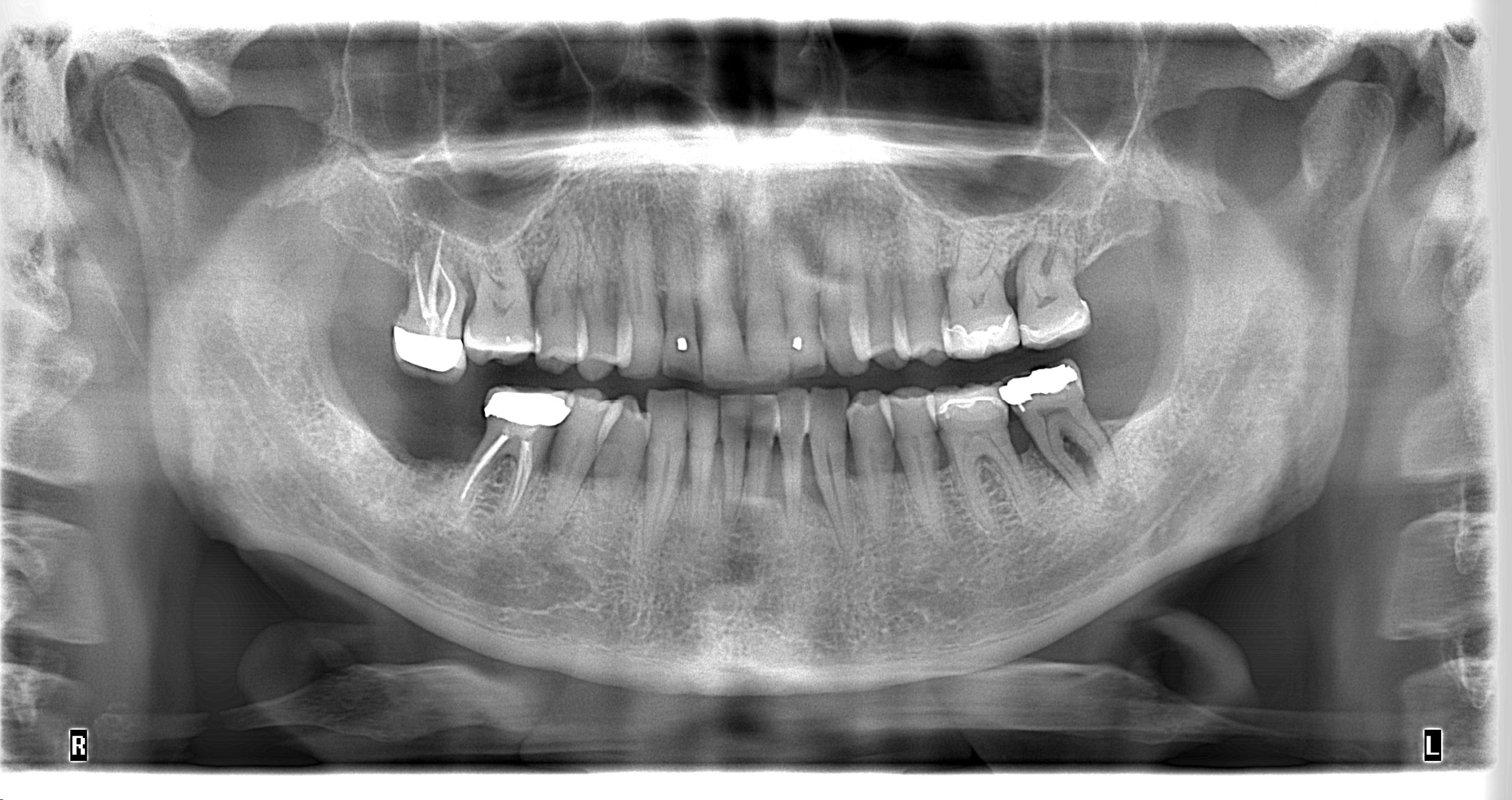 OPG dental x-ray of a patient showing endodontically treated tooth on the right molars 